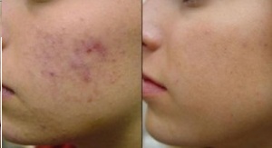 acido-glicolico-300x207