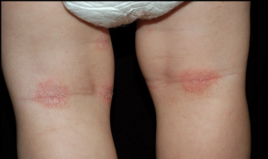 dermatitis atopica