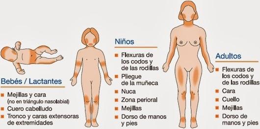 piel-atopica-da-alergia-