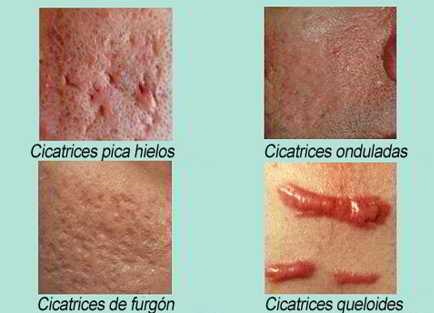 cicatrices-de-acne-1