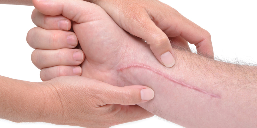 ¿Cómo tratar las cicatrices?